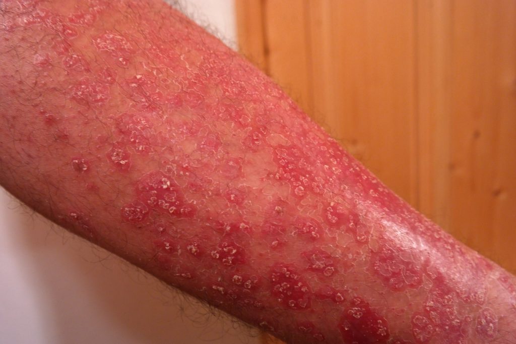 Castor oil for eczema