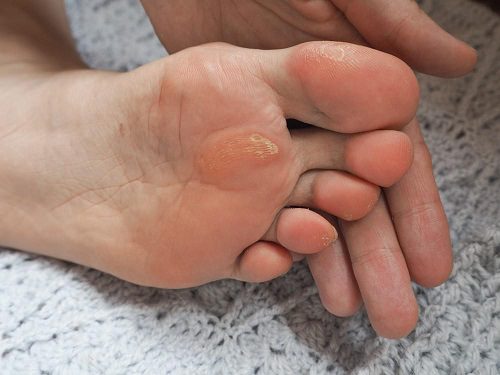 signs and symptoms of corns