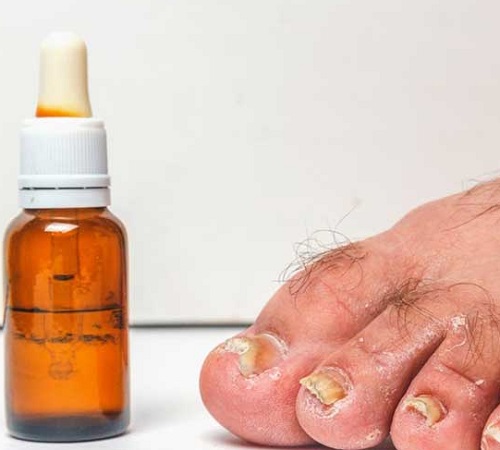 Does Castor Oil Help With Toenail Fungus? 1