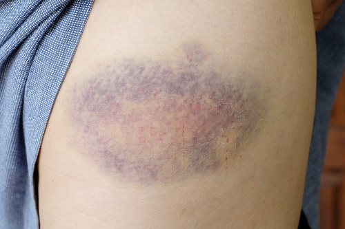 15 Best Essential Oils for Bruises 1