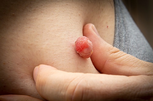 15 Most Effective Essential Oils for Skin Tags 1