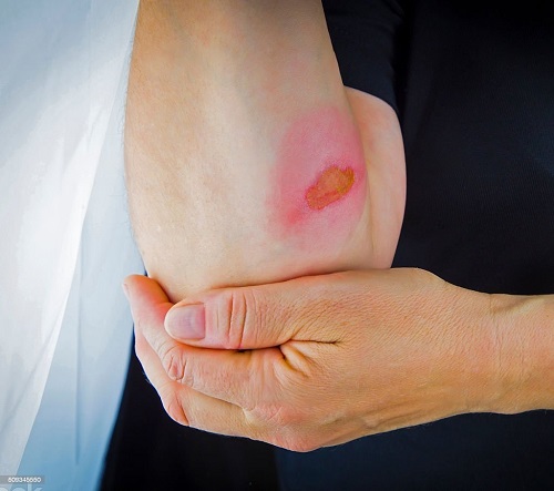 Essential Oils for Burns 1