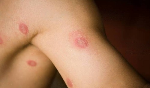 Essential Oils for Ringworm 1