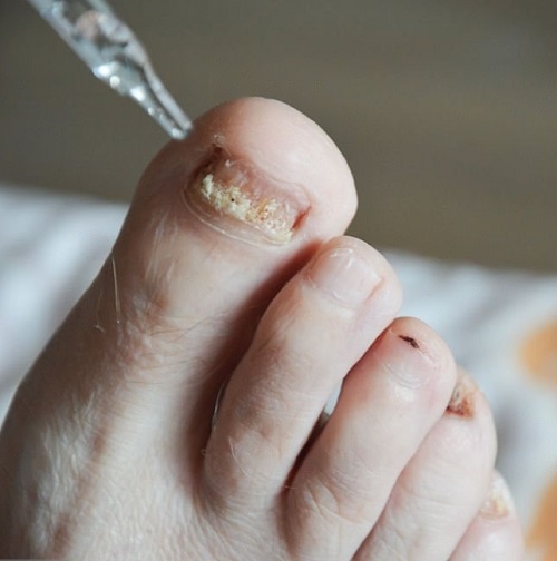 Oregano Oil for Nail Fungus | Benefits & Usage 2