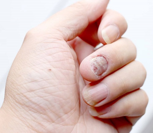 Oregano Oil for Nail Fungus | Benefits & Usage 1