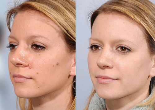 Castor Oil for Moles | Benefits and Usage 2