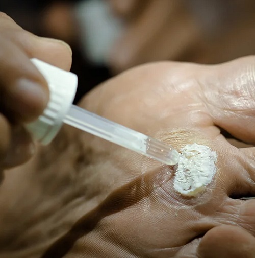 Castor Oil and Baking Soda for Warts 2