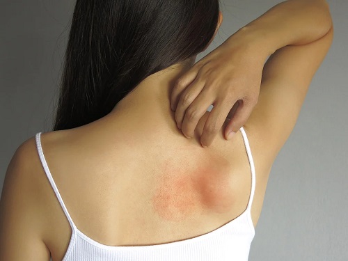 Is Castor Oil Good For Rashes? 2