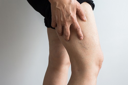 Does Castor Oil Help Spider Veins? 5