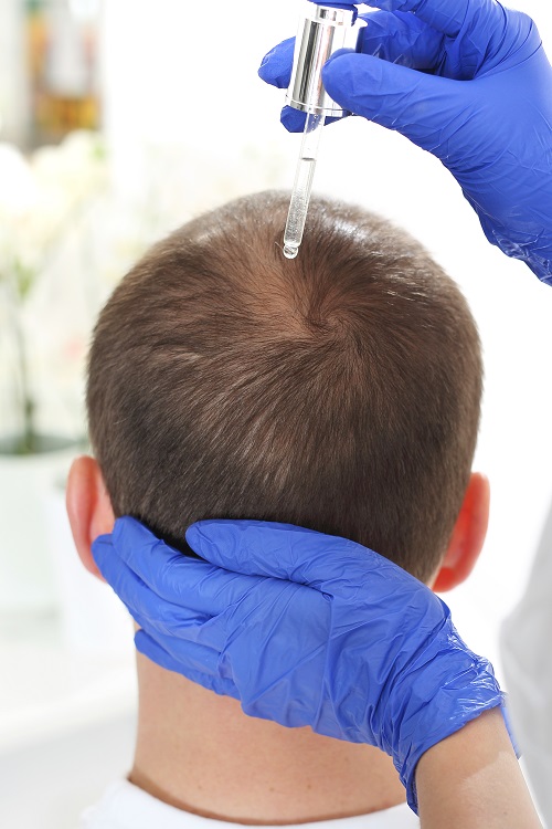 Castor Oil Grow Hair On Bald Patches 5