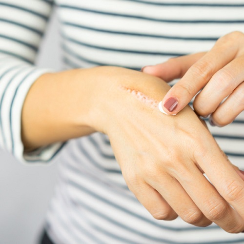 Castor Oil For Burn Scars 5