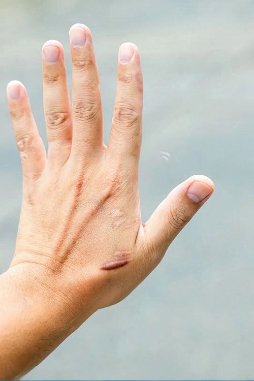 Keloids