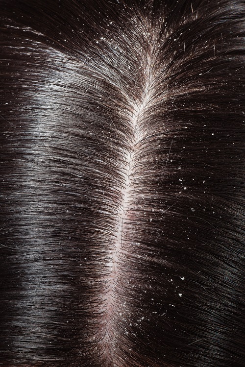 Dandruff 4