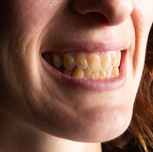 Does Coconut Oil Whiten Teeth