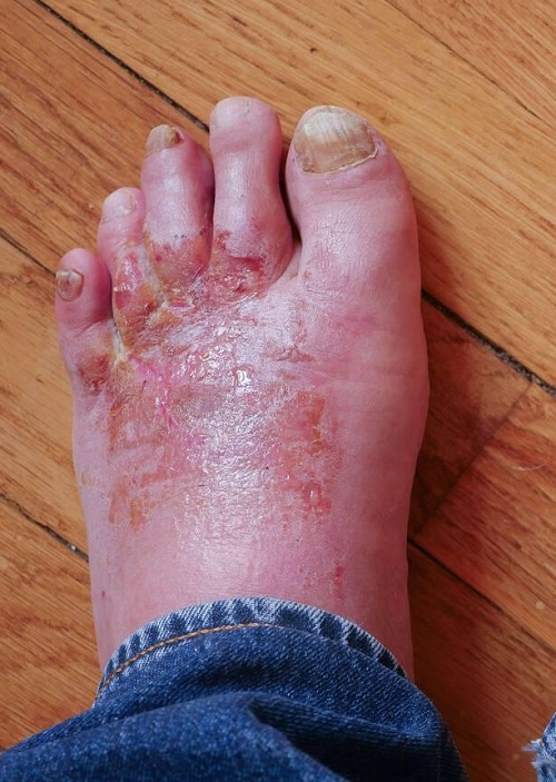 Neem Oil For Foot Fungus