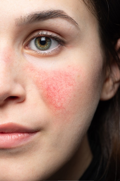 Reduces inflammation and redness