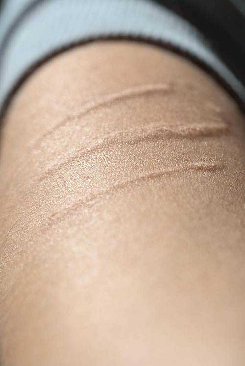 Scars Vaseline Can Heal