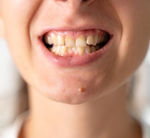 Castor Oil For Teeth Whitening