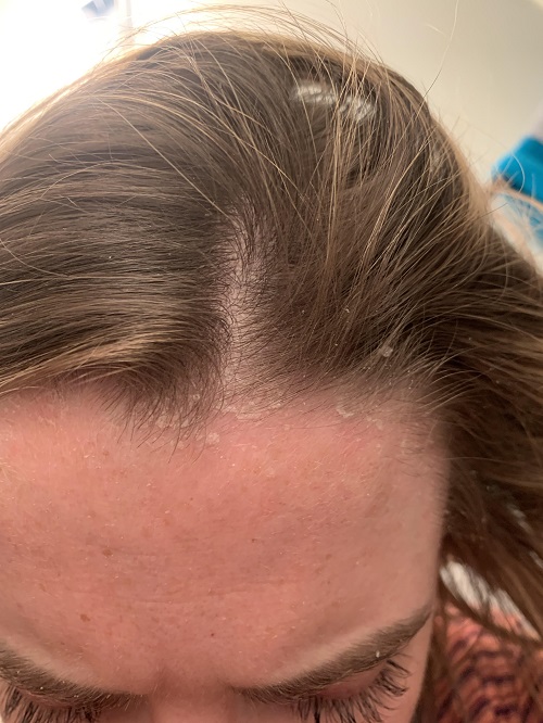 Causes of dandruff