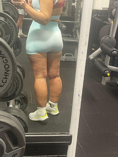 What Is Cellulite