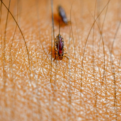 Remedies For Lice
