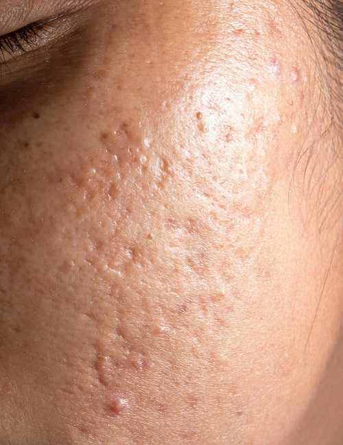 How to Use Olive Oil For Acne Scars