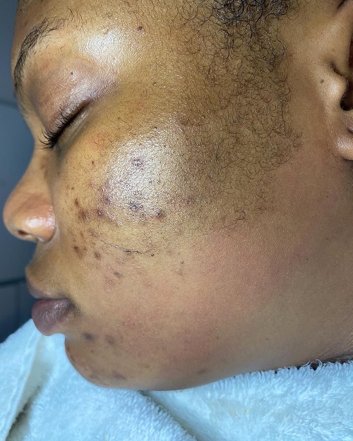 dead skin cells