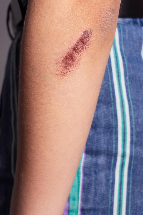Wound healing