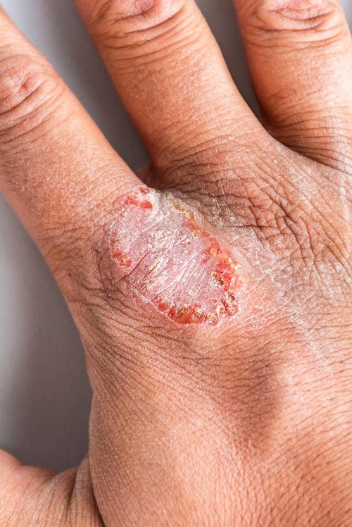 treating eczema
