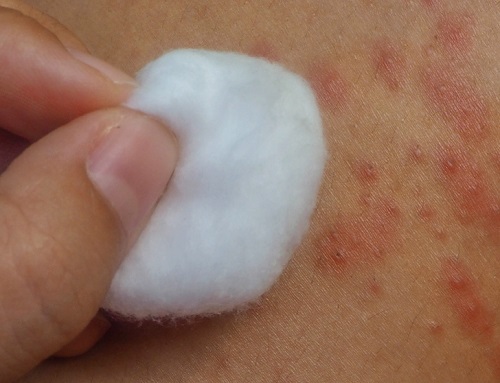 Use Castor Oil for Psoriasis