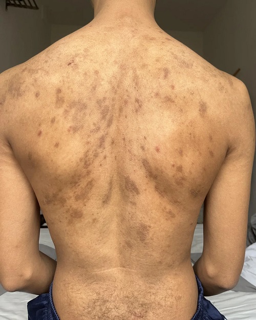 Back fungal Infection