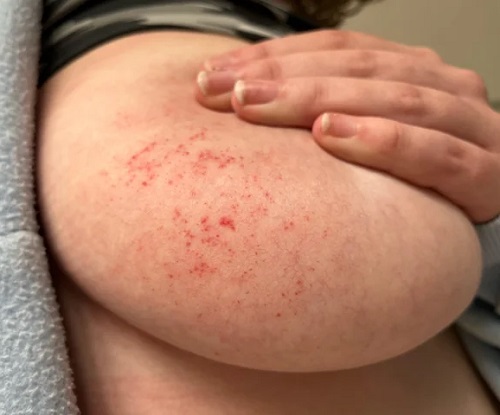 Breast Infections