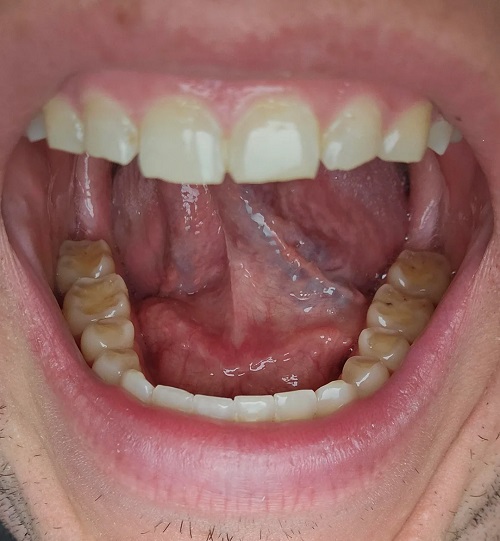 Erode Teeth