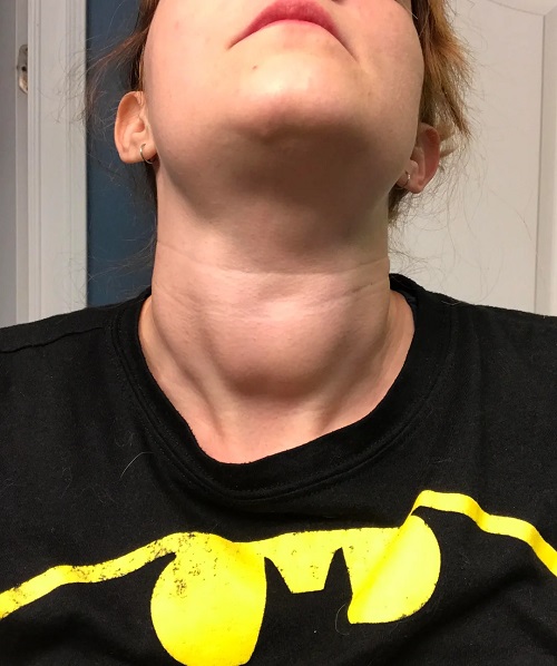 Castor Oil Work For Thyroid Health