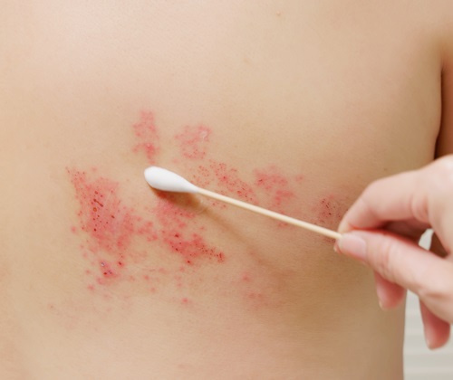 Remedy for skin diseases