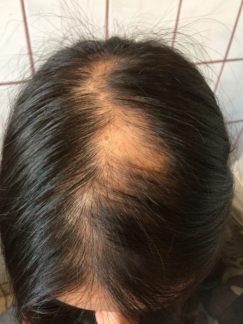 Hair Loss