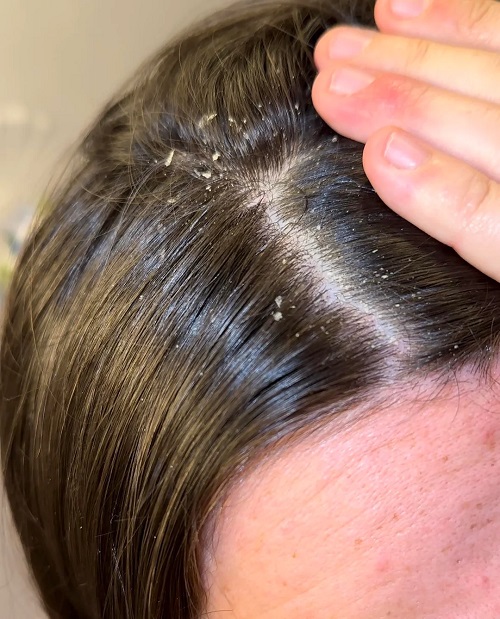 Dandruff Remedy