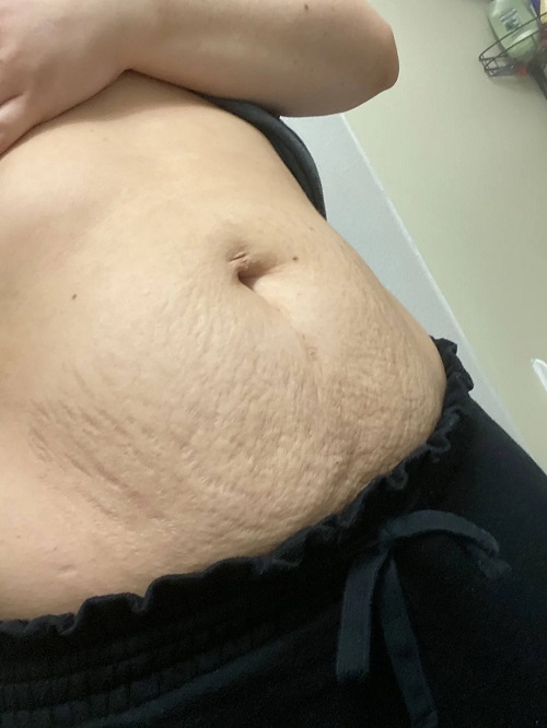 How To Use Coconut Oil For Stretch Marks