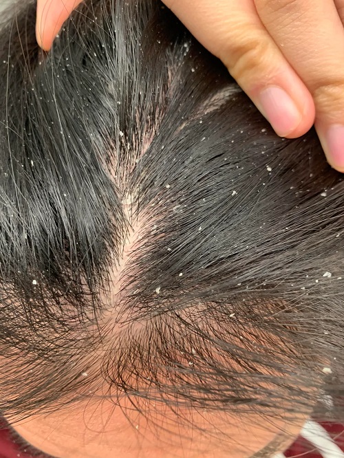 Oils That Cure Dandruff and Dry Scalp in Just a Few Uses 1
