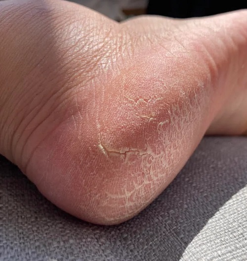 Cracked Heel