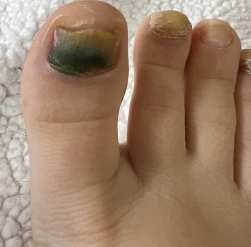 foot Fungal Infections