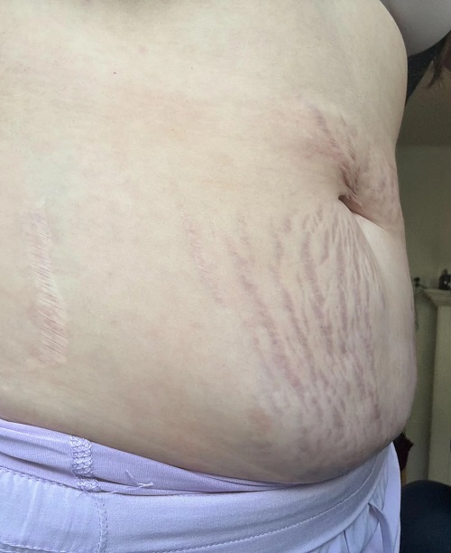 Stretch Marks