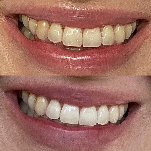Teeth Whitening
